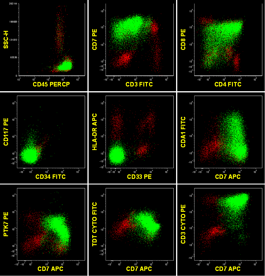 Flow cytometric analysis of PB sample at diagnosis showing the abnormal immunophenotype of T-lymphoid blasts (green)